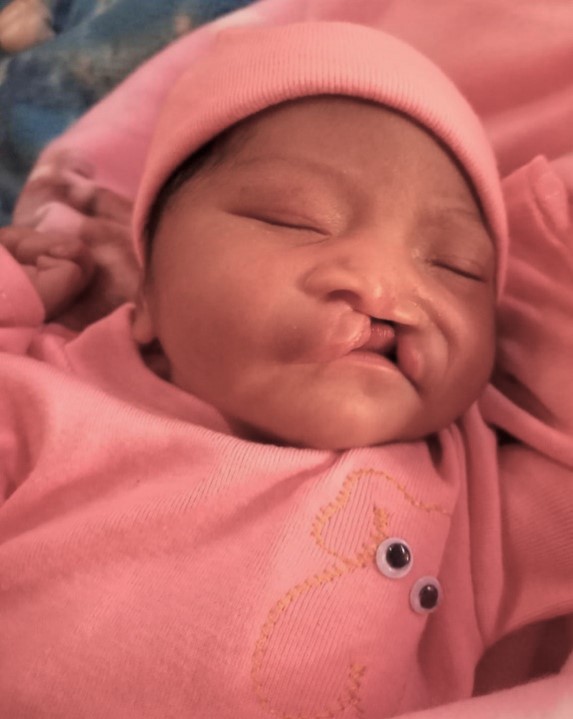 Cleft Lip and Palate in Guatemala:  Baby Ana