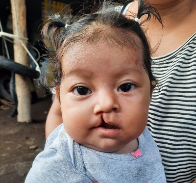 child in Guatemala with cleft palate