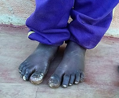child's diseased foot