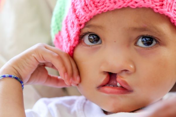 Girl with cleft lip wearing a pink and green hat