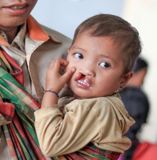 Girl in sling with cleft lip