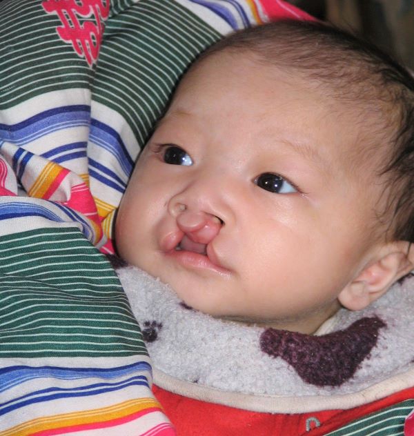 Baby with bilateral cleft lip in China