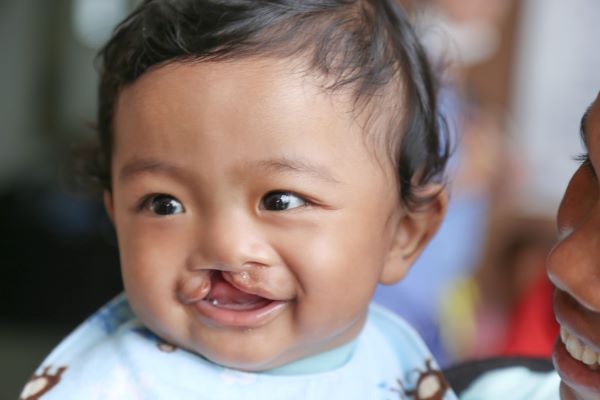 Smiling boy with cleft lip