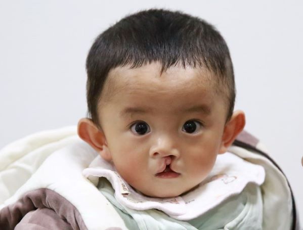 Baby boy from China with cleft lip