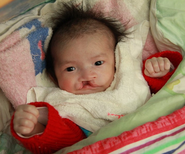 Baby with bilateral cleft lip