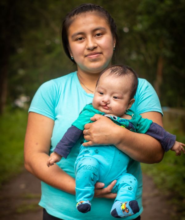 Young mom holding baby boy with cleft lip in Guatemala