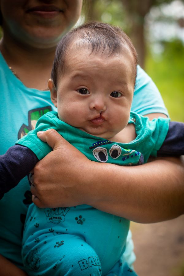 Baby boy with cleft lip in Guatemala