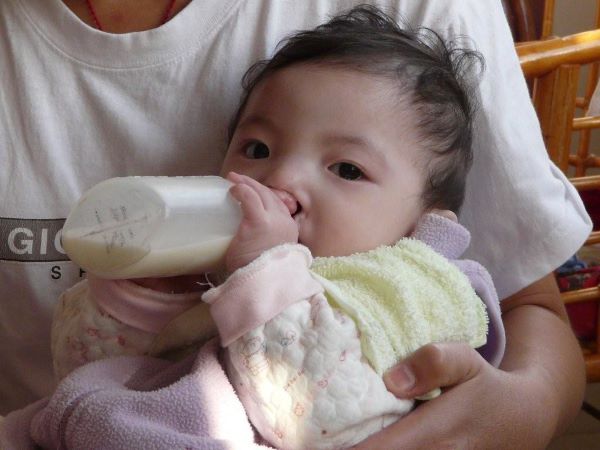 Baby with cleft lip drinking from cleft bottle