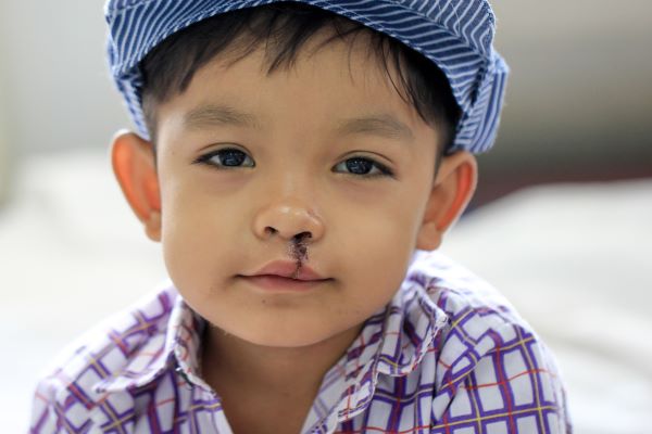 Boy with cap after cleft lip surgery