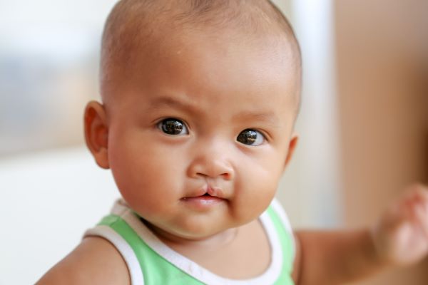 Child with microform cleft lip