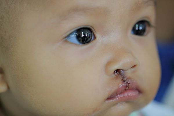 Child following cleft lip repair