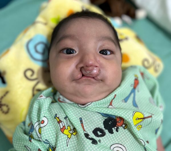 Baby boy with cleft lip making faces