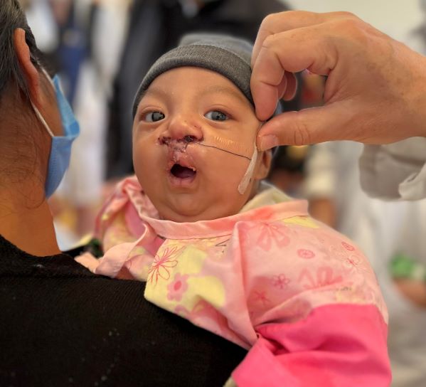 Baby boy gets tape off after cleft repair surgery