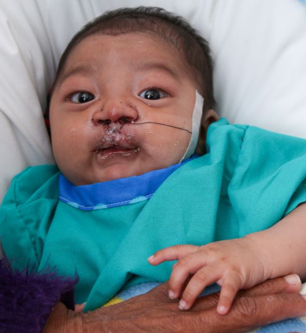Baby boy in green following cleft lip repair surgery