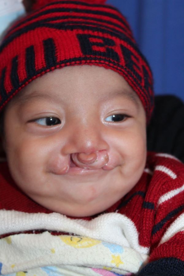 Baby boy with cleft lip in red hat and sweater
