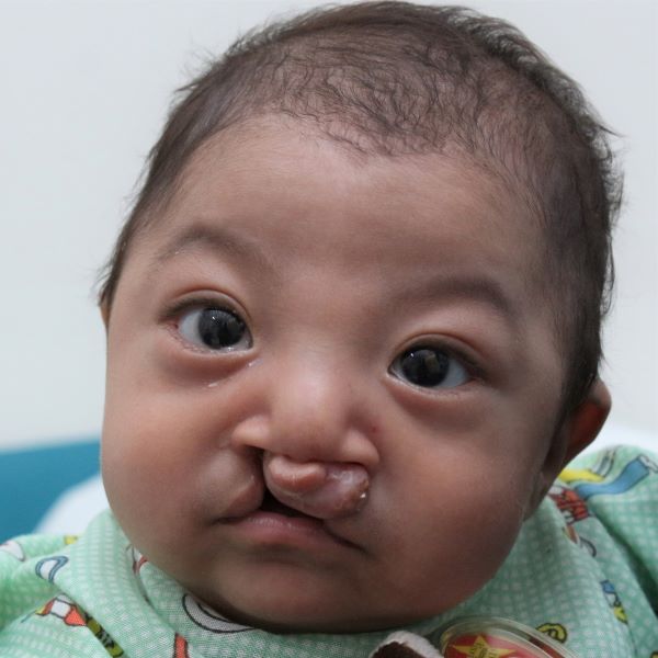 Guatemalan boy with cleft lip