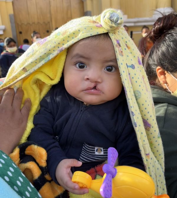 Baby boy with cleft with blanket on his head