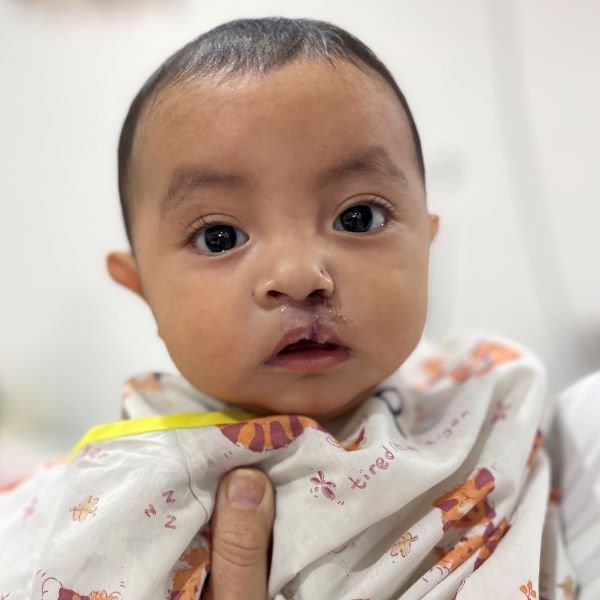 Baby boy following cleft repair surgery