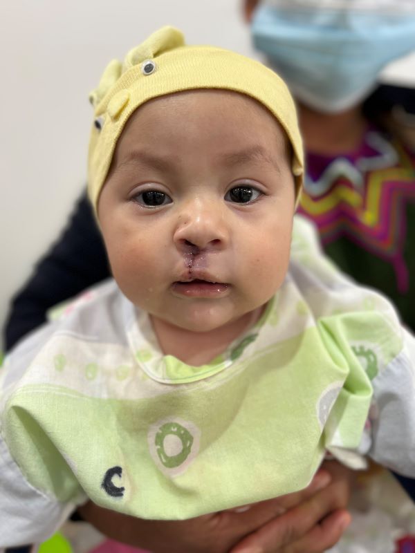 Girl in yellow hat following cleft surgery