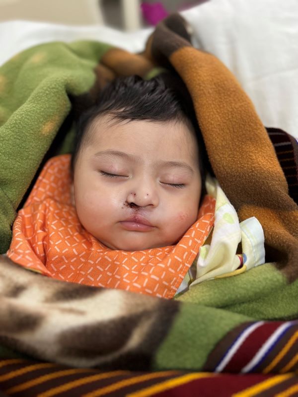 Sleeping baby boy after cleft lip repair surgery