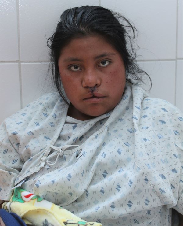 Teenage girl right after cleft lip repair