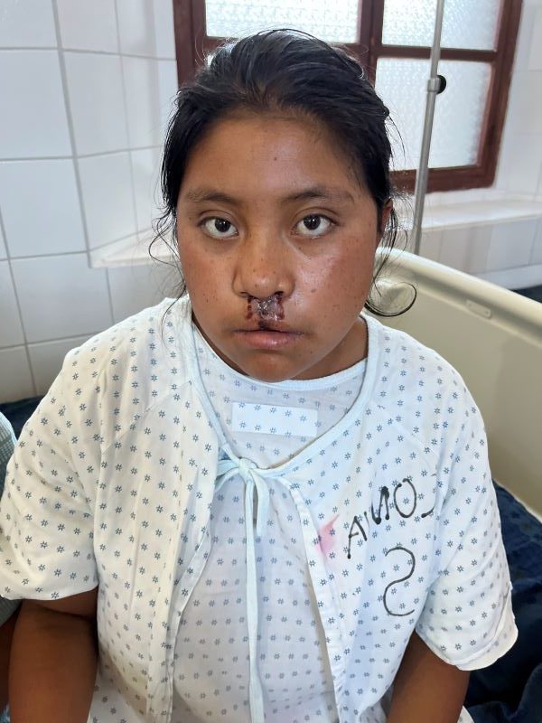 Teenage girl in hospital following cleft repair surgery