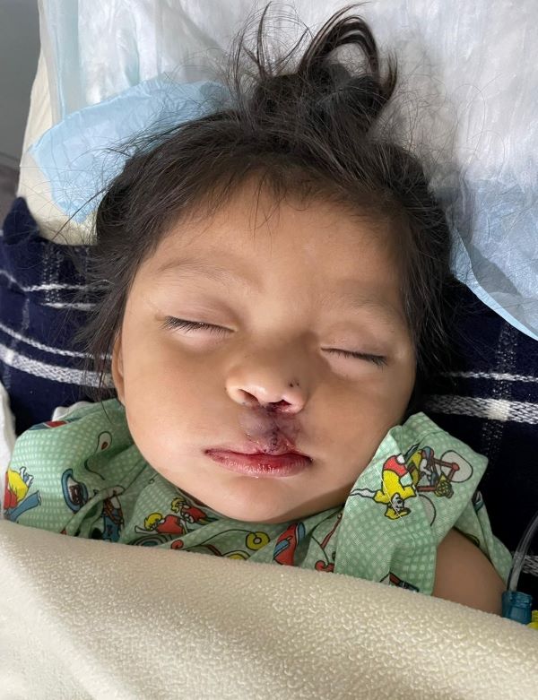 Sleeping baby after cleft lip repair