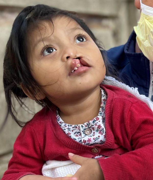 Girl with cleft lip in red sweater