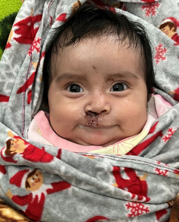 Guatemalan baby following cleft lip surgery