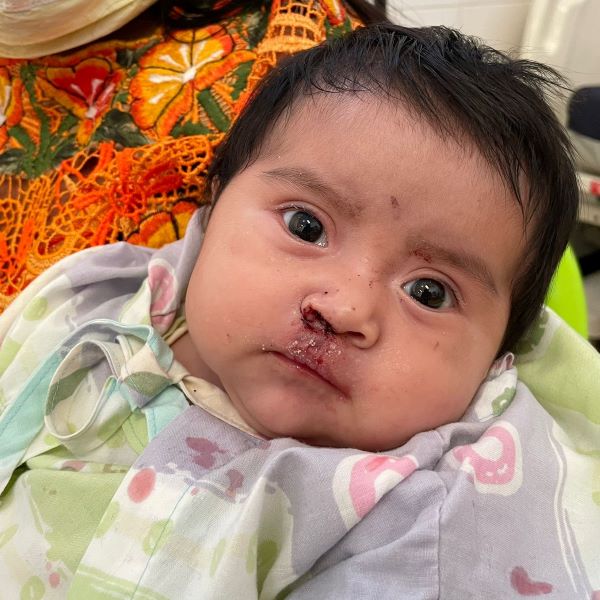 Guatemalan baby after cleft lip surgery