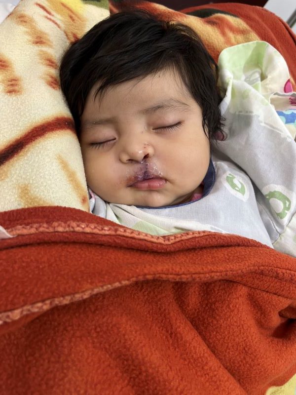 Sleeping baby after cleft lip surgery