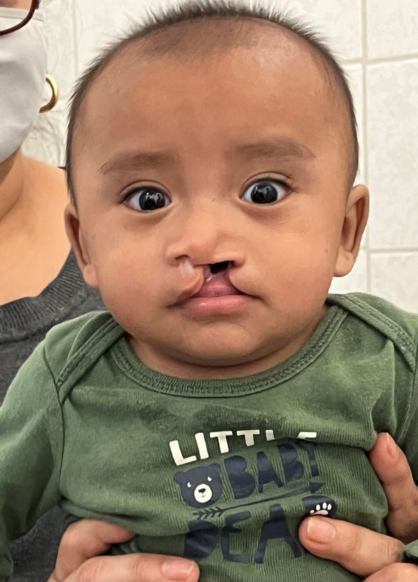 Guatemalan boy with cleft lip