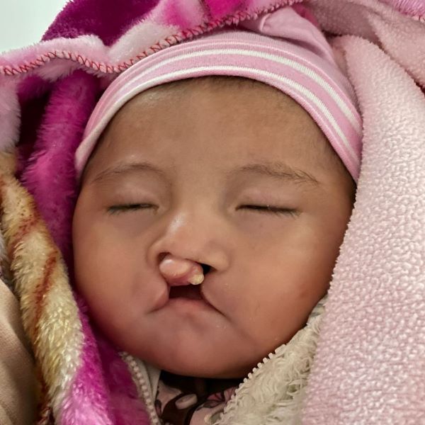 Baby in pink with bilateral cleft lip