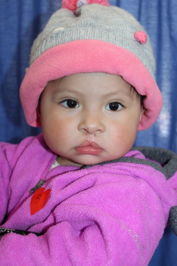 Suspicious girl with cleft palate in Guatemala
