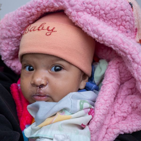 Guatemalan baby after cleft lip repair surgery