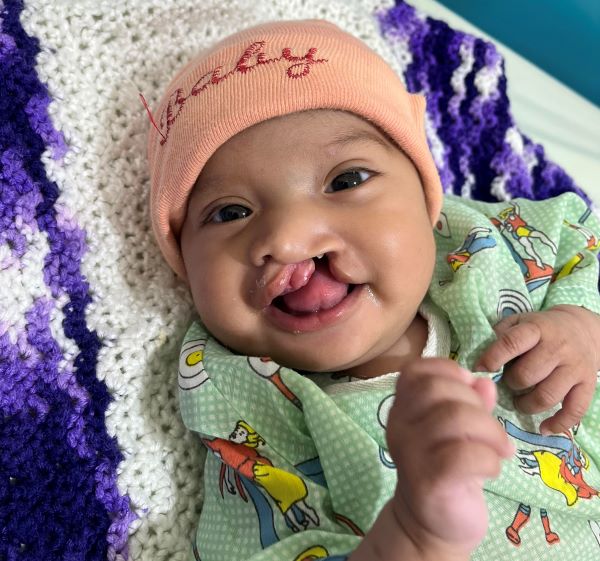 Guatemalan baby with cleft lip smiling