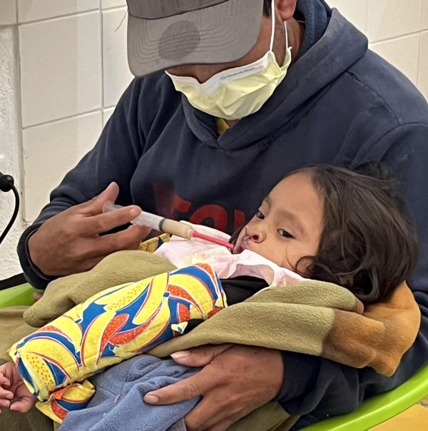 Father feeding daughter with cleft lip with syringe