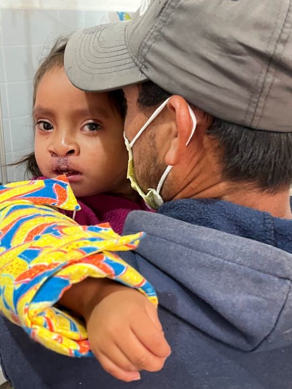 Little girl being soothed by her father after cleft surgery