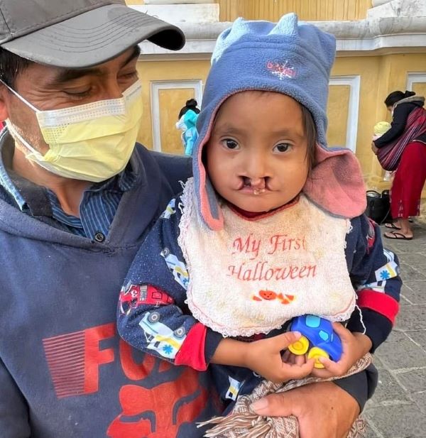 Guatemalan father and daughter with bilateral cleft lip