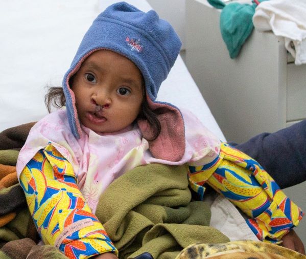 Guatemalan girl after cleft lip surgery