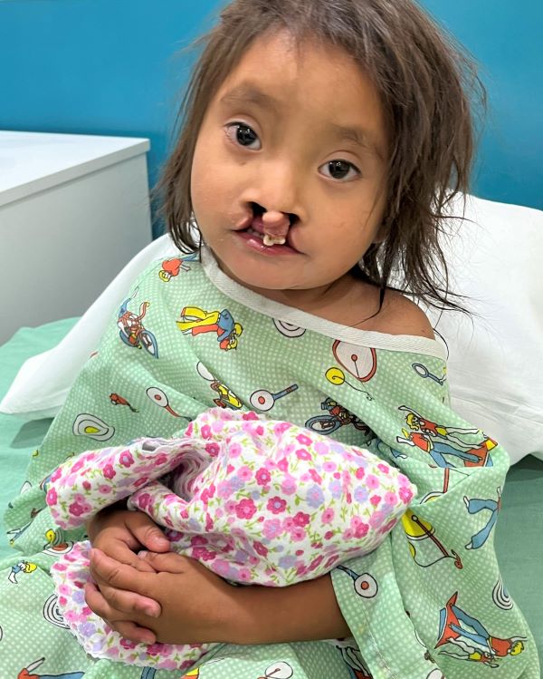 Guatemalan girl with bilateral cleft lip holding a toy baby