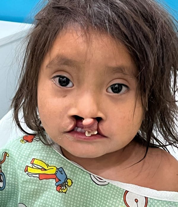 Guatemalan girl with bilateral cleft lip