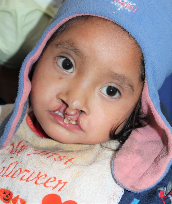 Guatemalan girl with bilateral cleft lip