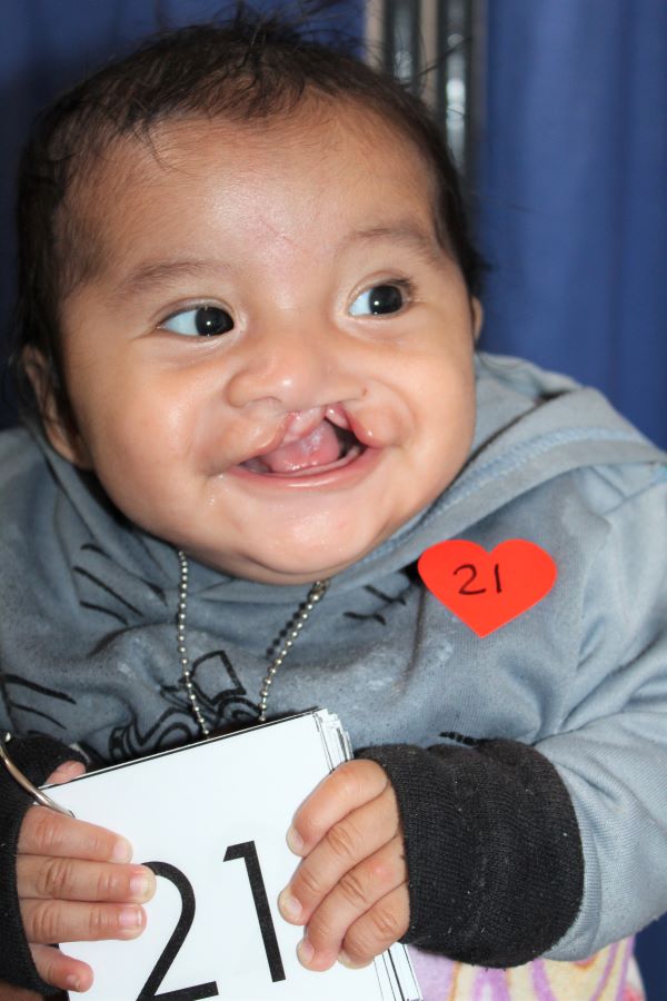 Boy with cleft lip holding number 21 preparing for surgery