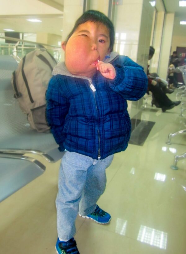 Boy with large facial tumor eating lollipop in airport