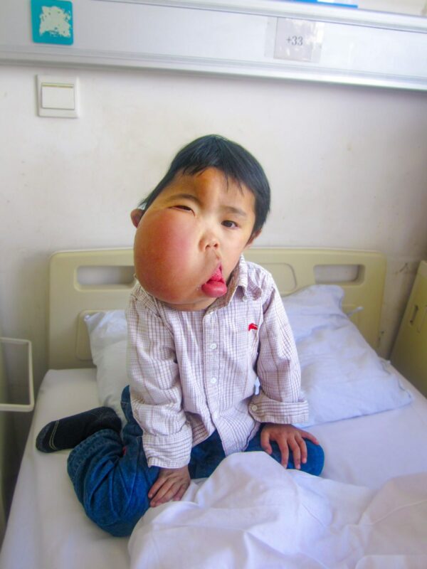 Boy with large facial tumor in hospital