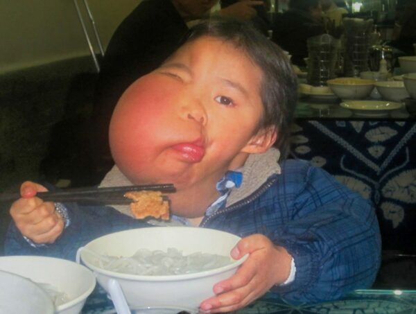 Boy with large facial tumor eating with chopsticks