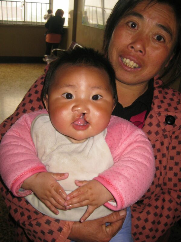 Baby with cleft lip and chubby cheeks being held by her mother in a hospital