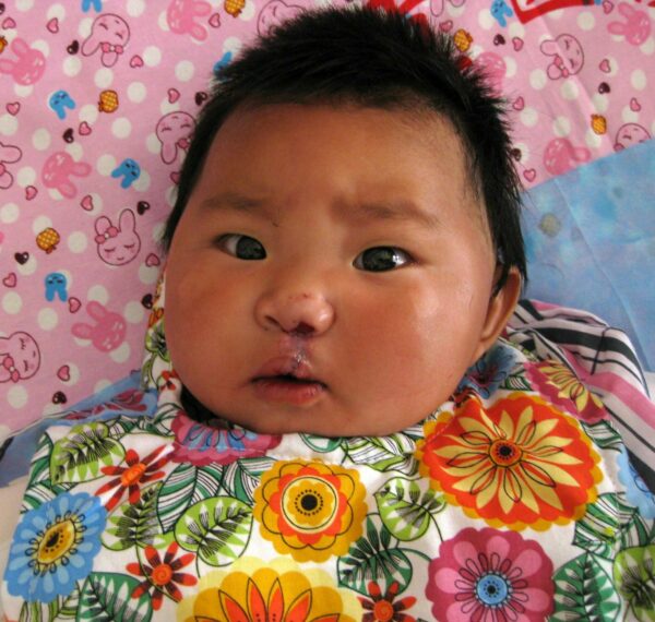 Baby with a repaired cleft lip lying on a pink sheet