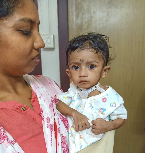 Indian mother and baby with tracheostomy